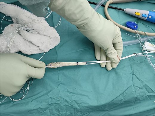 Hamstring allograft with high-strength suture augmentation. The sutures run beside the allograft.