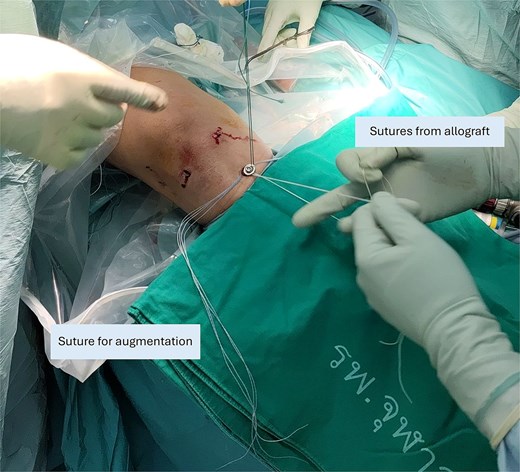 Suture-to-post fixation at the proximal tibia. The sutures from the graft ends are being tied. The sutures for augmentation are tied afterwards.