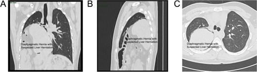 CT scan views of the thoracic hernia with suspected liver tissue involvement: (A) Axial view. (B) Frontal view. (C) Sagittal view.