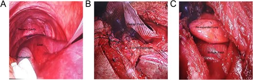 Intraoperative images: (A) Laparoscopic view showing the liver herniated into the right thoracic cavity; (B) Diaphragm repair to secure the mesh; (C) Successful re-expansion of the right lung.