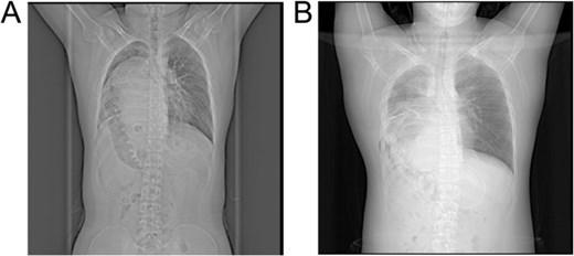 X-ray images: (A) Preoperative X-ray showing a suspected liver mass occupying the right thoracic cavity; (B) Postoperative X-ray showing re-expansion of the right lung and the liver returned to the abdominal cavity.