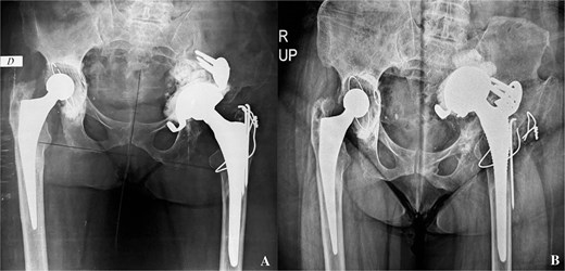 A- revision of the left total hip arthroplasty: postoperative pelvis X-ray. B- pelvis X-ray: Intrapelvic migration of acetabular components (Kerboul cross-plate and the cup).