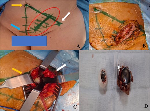 A- drawing of the scar of the para-rectus approach. Bony landmarks: right arrow: anterior superior iliac spine, up left arrow: umbilicus, bottom left arrow: pubic symphysis. B- scar size. C- intraoperative view of the acetabular implant before their extraction. The left arrow corresponds to the medial part where there are the lateral iliac vessels protected. The right arrow corresponds to the lateral part with the iliopsoas muscle spread apart. D- acetabular implants removed.