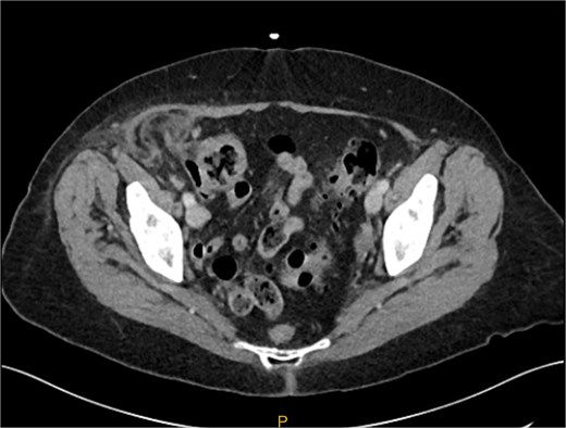 Preoperative CT image of right inguinal hernia. It is difficult from the images to determine if the hernia sac contains an appendix.