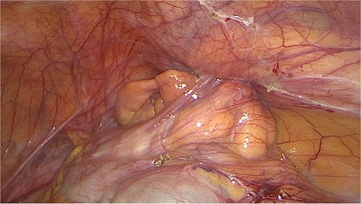 Intraoperative image of inflamed appendix within the internal inguinal ring.