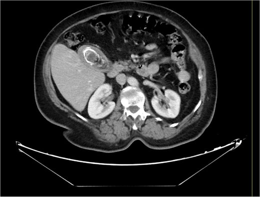 Computed tomography of the abdomen and pelvis before the procedure.