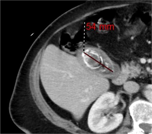Computed tomography of the abdomen and pelvis showing a 54 mm gallbladder stone.