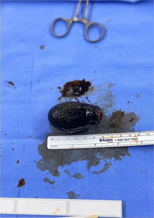 The size of the gallbladder with a measurement tape after the procedure.