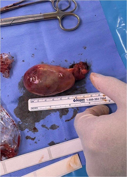 Another figure of the size of the gallbladder after the procedure.