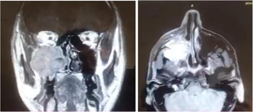 MRI image of right maxillary sinus-centered AC.