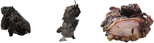 The excised ameloblastic tumor mass of the right maxillary sinus.