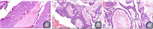 Histopathological findings of specimen at lower magnification.