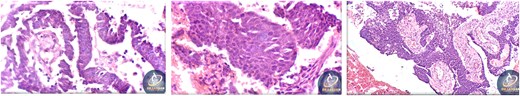 Histopathological findings of specimen at higher magnification.