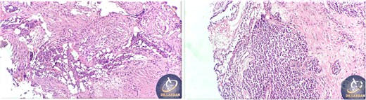 Tumor extension to the orbital floor and buccal mucosal surgical margin.