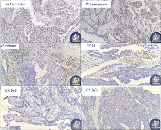 Ancillary studies for CK 5/6, P63, CK19, SOX-2, SOX-10, calretinin, and Ki67.