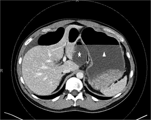 CT scan. Unusual dilated and fluid-filled small bowel (white star) behind the distended stomach (white triangle).