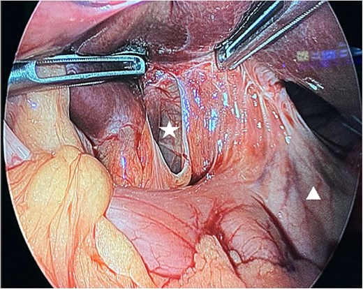 Intra-operative findings. A defect in the lesser omentum (white star). The stomach (white triangle).