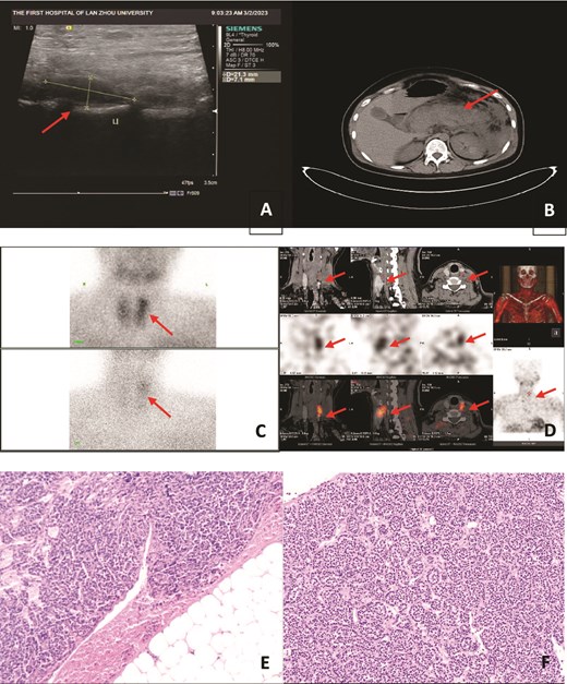 (A) Hypoechoic area posterior to the upper pole of the left lobe of the thyroid gland; (B) acute pancreatitis with necrotic changes, with acute necrotic material accumulation around the pancreas; (C, D) Imaging after 30 min of intravenous injection of 99mTc-MIBI: the thyroid gland was still clear, and a dense area of abnormal tracer distribution was seen above the left lobe of the thyroid gland; imaging after a delay of 2 hr showed that the tracer distribution in the glands of both lobes of the thyroid gland was markedly reduced, and a dense area of abnormal tracer distribution was still seen above the left lobe of the thyroid gland; (E, F) morphological and immunohistochemical results support parathyroid adenoma (HE staining, 10 × 10).