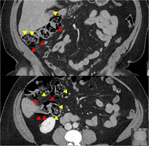 Coronal and axial CT slices showing pneumatosis in the right colon. Arrowheads demonstrate subserosal and submucosal gas.