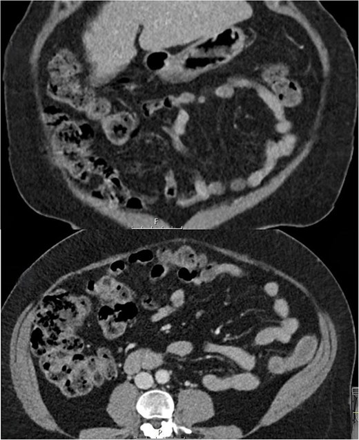 Follow up coronal and axial CT slices at 6 weeks showing resolution of PC.