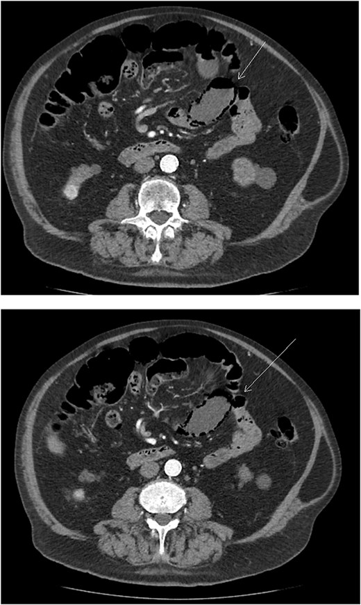Axial abdominal CT scan image where the arrow points to the presence of pneumatosis intestinalis.