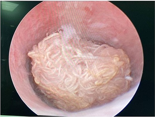 Cystourethroscopy showing a retained spongiform structure in the urethra.