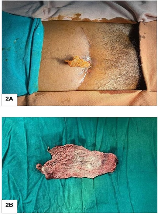 A piece of surgical gauze protruding through the suprapubic cystostomy site after trial of antegrade cystoscopic removal (A) and postoperative picture showing the removed surgical gauze (B).