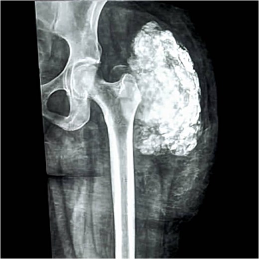 The X-ray of the left upper thigh and hip shows a calcified mass with a well-defined margin (“chicken wire” pattern calcification).