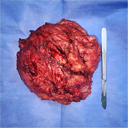 Shows the excised mass measuring 16 × 12 cm.