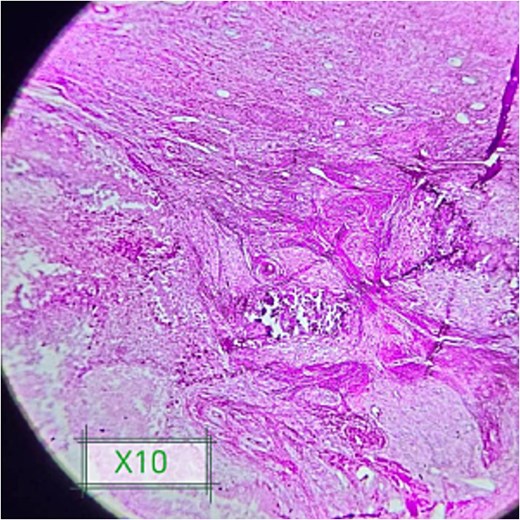 Shows foci of amorphous calcium deposits surrounded by foreign giant cells and fibrosis.