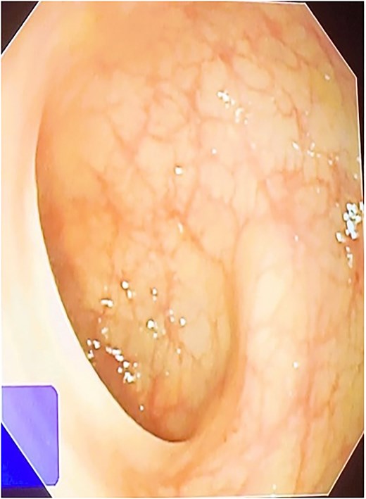 Sigmoidoscopy was found to be normal.