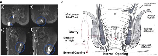 (a) Magnetic resonance imaging of the fistula a trans-sphincteric fistula extending up to the thigh. (b) Diagrammatic representation of fistulous tract.