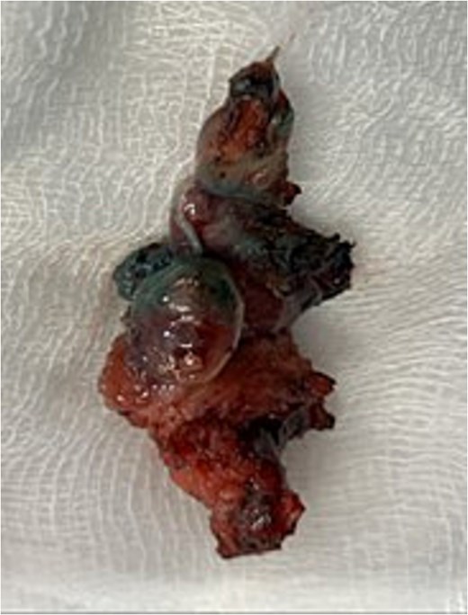 Excised specimen of fistulous tract.