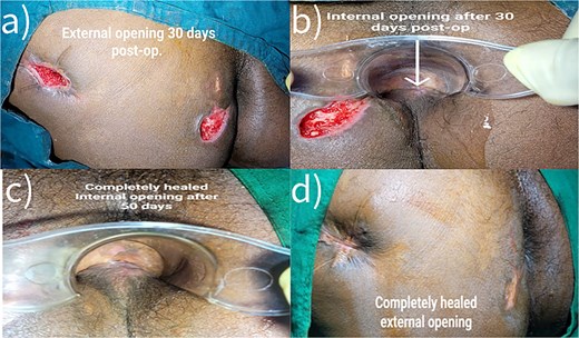 Postoperative Day 30 and Day 50 completely healed.