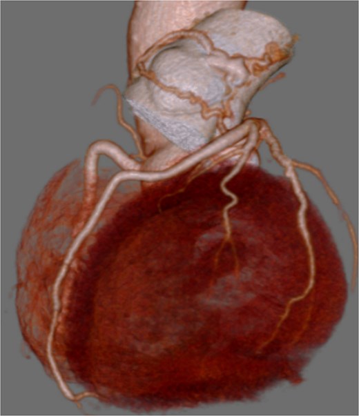 Preoperative coronary CT showing coronary artery-pulmonary artery fistula.