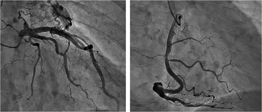 Preoperative CAG showing coronary artery-pulmonary artery fistula and 75% stenosis of the right coronary artery.