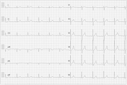 ECG at rest showing no ST changes.