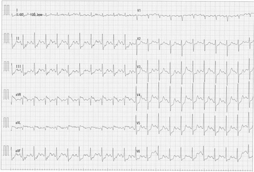 Exercise ECG showing diffuse ST depression.