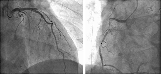Intraoperative CAG revealing vasospasms along the entire length of the RCA and OM artery.