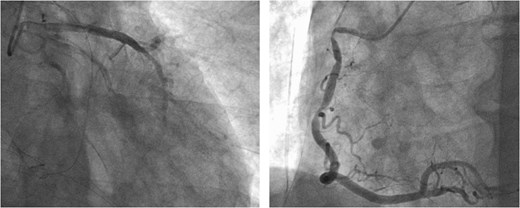 CAG after administration of nitroglycerin.