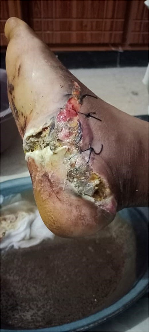 Initial presentation of bilateral open calcaneal fractures in Case 1, showing extensive tissue damage on the right foot.