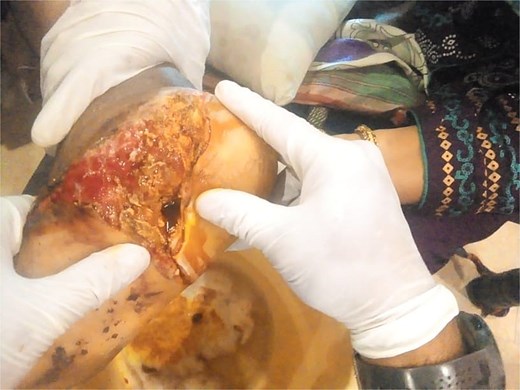 Initial presentation of bilateral open calcaneal fractures in Case 1, showing tissue damage on the left foot.