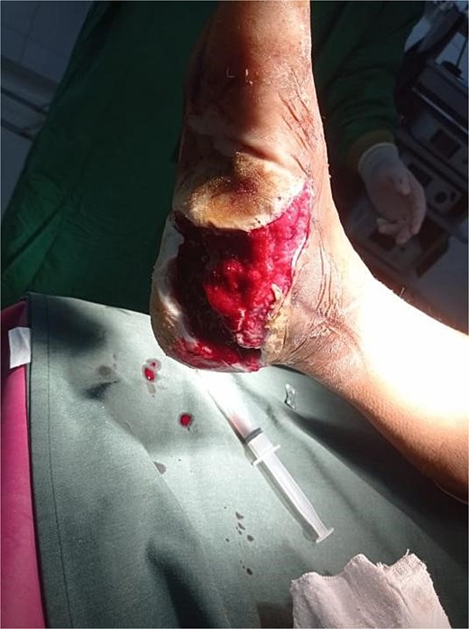 Granulation tissue development on Day 3 of VSD treatment in Case 1.