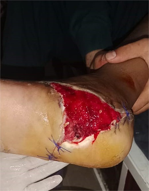 Wound healing progress in Case 1 after 1 week of follow-up.