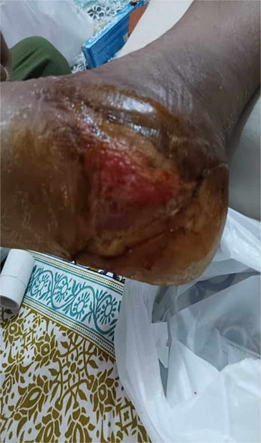 Further improvement in wound healing in Case 1 after 2 months of follow-up.