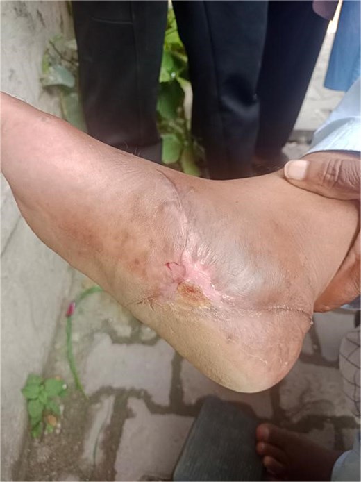 Complete wound closure in Case 1 at the end of the 4-month follow-up.