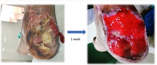 Healthy granulation tissue development in Case 2 after 1 week of VSD treatment.