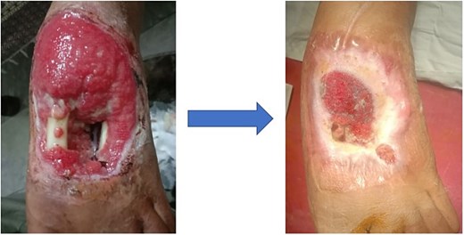 Initial presentation and follow up of an infected open foot fracture with bone loss in Case 3.