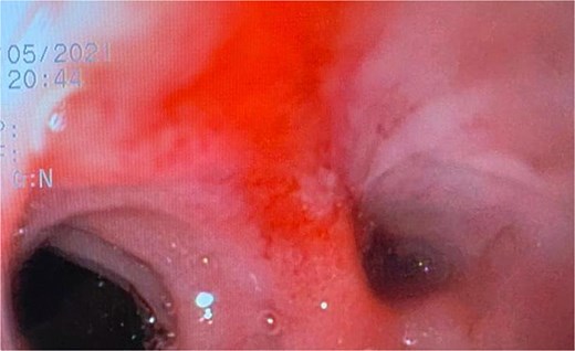 A fistulous opening is evident during the initial endoscopy.