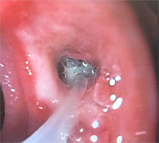 The placement of the catheter and sponge for EVAC therapy is observed.